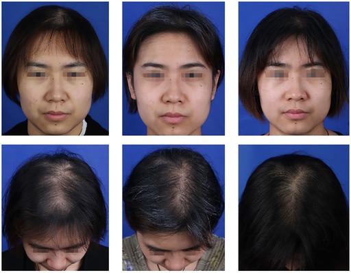 . Images of the experimental group patient receiving rb‐FGF combined with FUE treatment: pretreatment (left), 6 months posttreatment (middle), and 12 months posttreatment (right). Postoperative observation: The patient exhibits notably dense hair growth, indicating excellent treatment results.