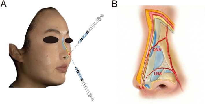 FIGURE 2. Schematic diagram of CaHA injection in nasal augmentation. (A) Schematic representation of nasal augmentation using a blunt cannula at the supraperiosteal plane. The red dot indicates the injection entry point at the nasal tip. The yellow line indicates the midline placement of the CaHA product. (B) High‐risk arterial zones in the subcutaneous layer: Lateral nasal artery (LNA), dorsal nasal artery (DNA), and columellar artery (CA). CaHA (blue) is deposited in the sub‐SMAS plane along the dorsum and columella, with careful avoidance of these arteries.
