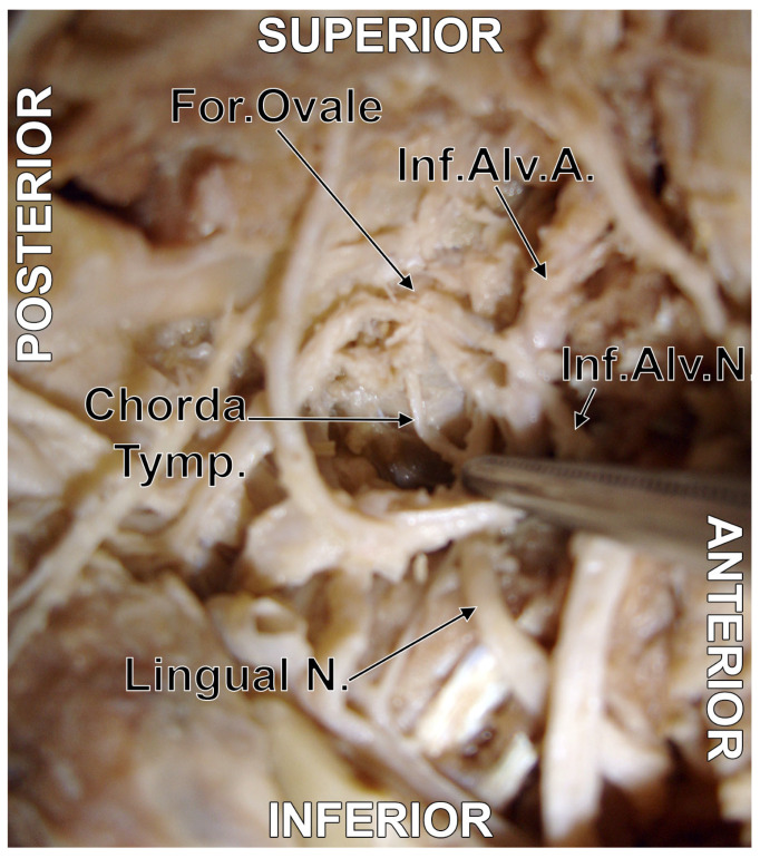 Figure 3. The chorda tympani–lingual nerve junction. Original dissection of the right infratemporal fossa. Infero-lateral view. Key labelled structures: chorda tympani, lingual nerve (V3), junction point, lateral pterygoid muscle.