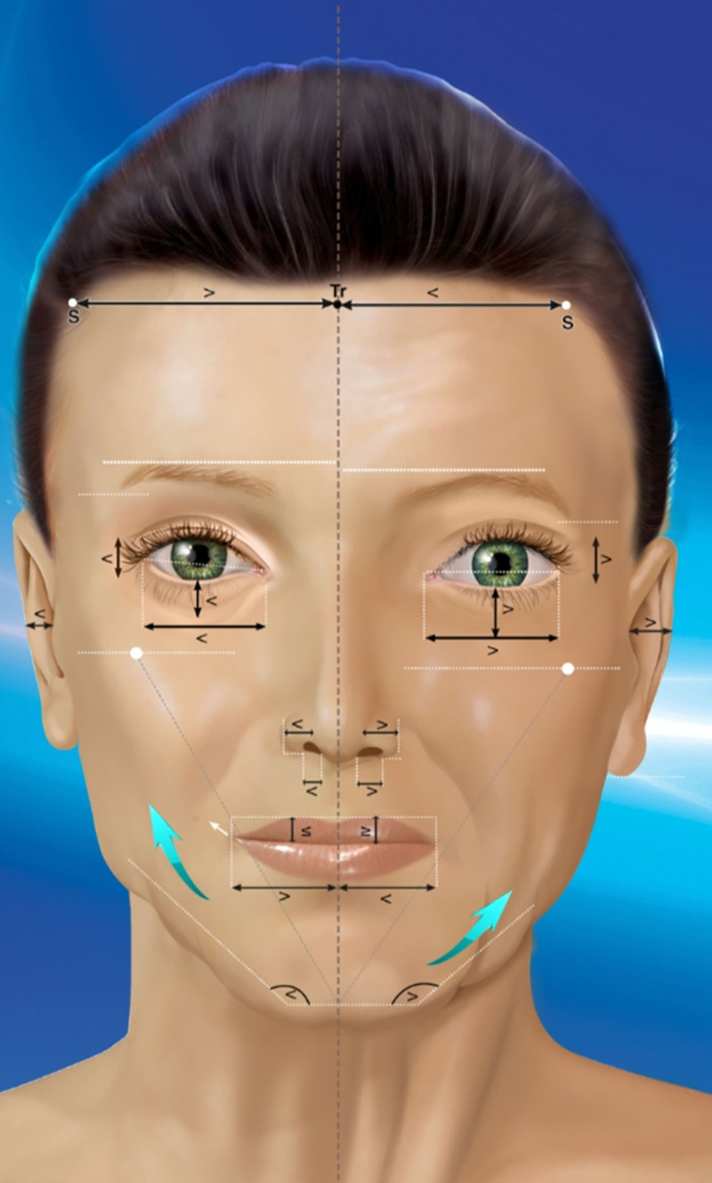 3D颈部提升颏下解剖动态矫正