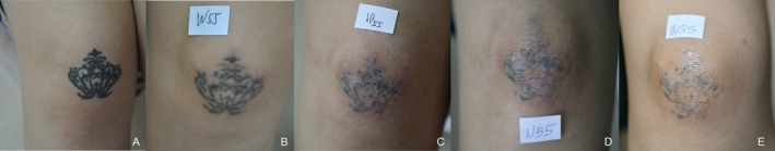 皮秒与Q开关1064nm激光洗纹身对比:总体疗效相当,皮秒激光优等清除率更高、所需次数更少