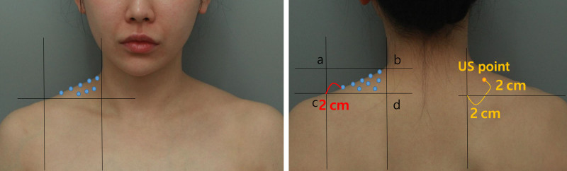 Incobotulinumtoxin-A 注射缩小斜方肌的回顾性研究:22 例影像定量评估