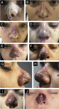 肉毒毒素与真皮填充剂在面部美学应用中的不良反应:一篇叙述性综述