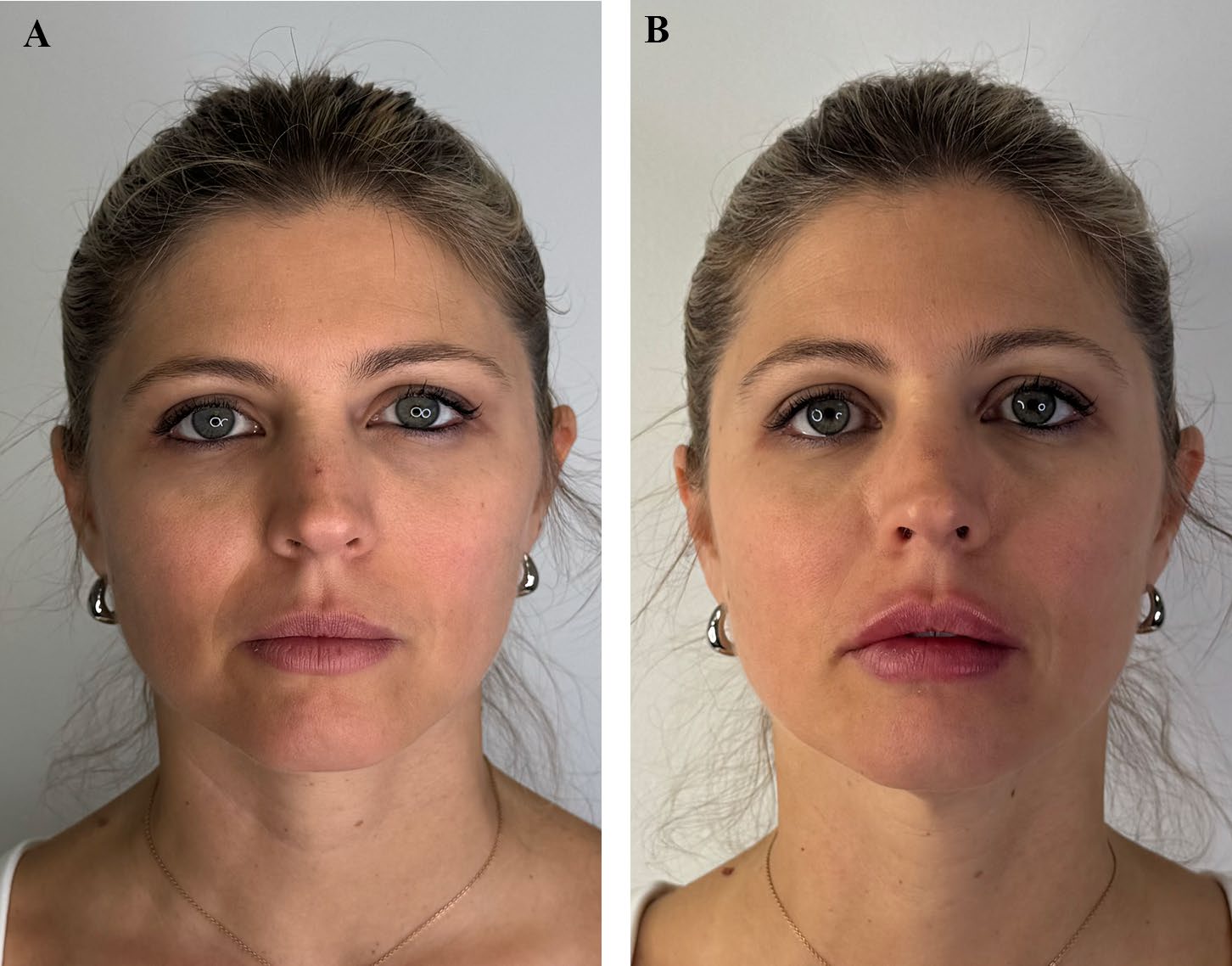 Fig. 6 — (A) Pre-operative frontal view in a 32 years old patient. (B) Post-operative frontal view in the Figure 6A patient who underwent lip filler with iLips technique