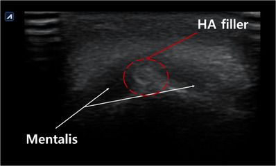 FIGURE 3. Schematic image of the mentalis muscle with chin augmentation using hyaluronic acid filler.
