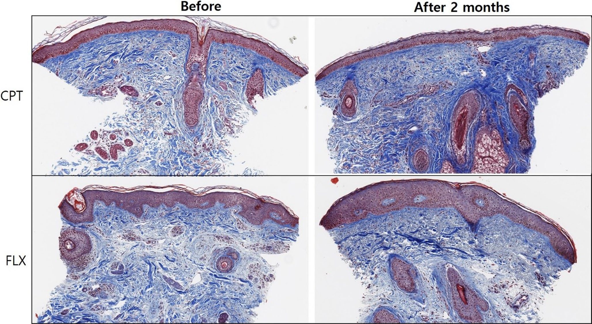 Fig. 2 Histologic samples derived from older adult participants and stained for collagen fibers using Masson's trichrome; original magnification, ×40. CPT tip-treated sample exhibits a more significant increase in collagen fiber density after treatment.