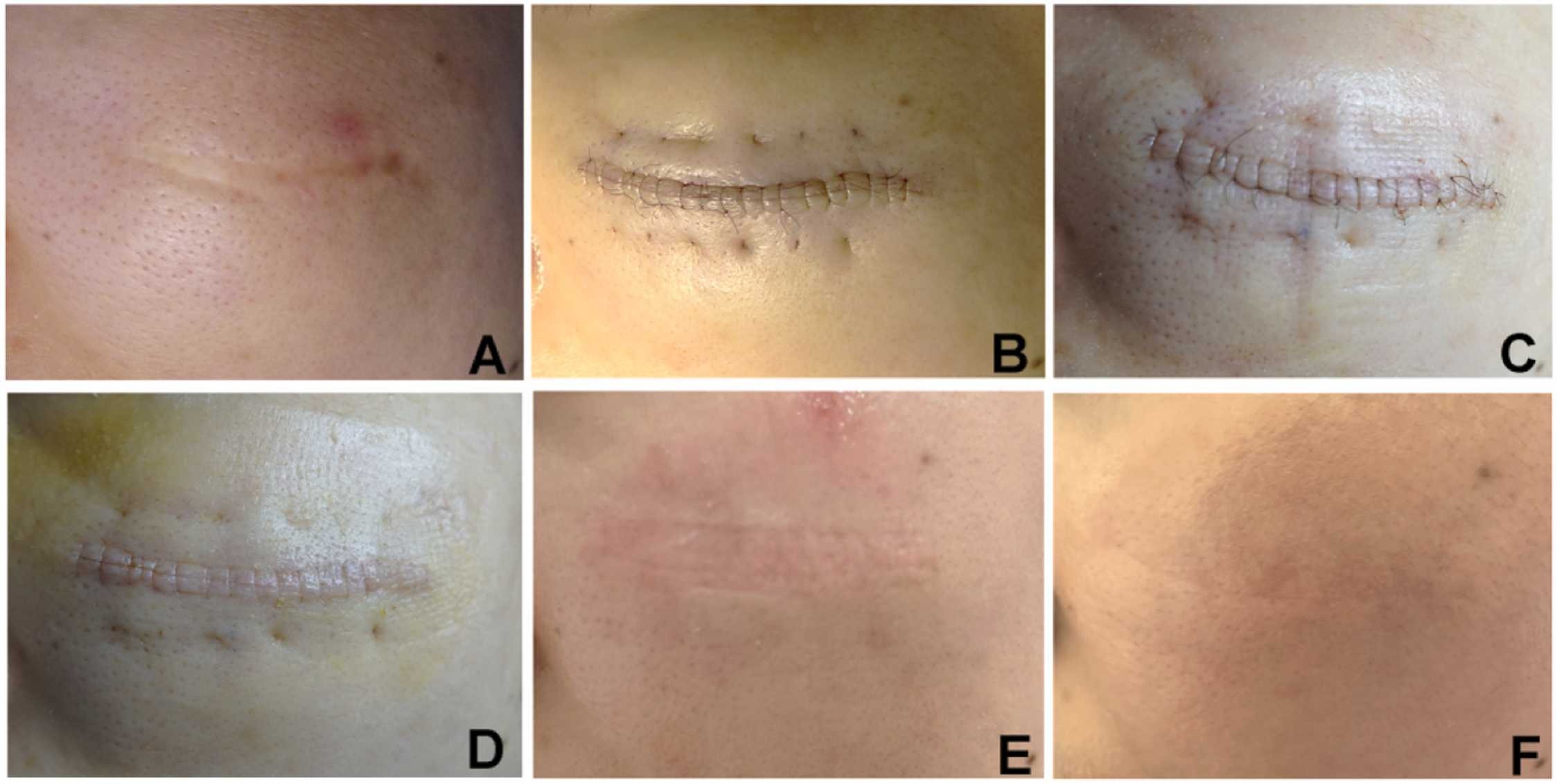 Figure 2: Traditional external suture healing effect